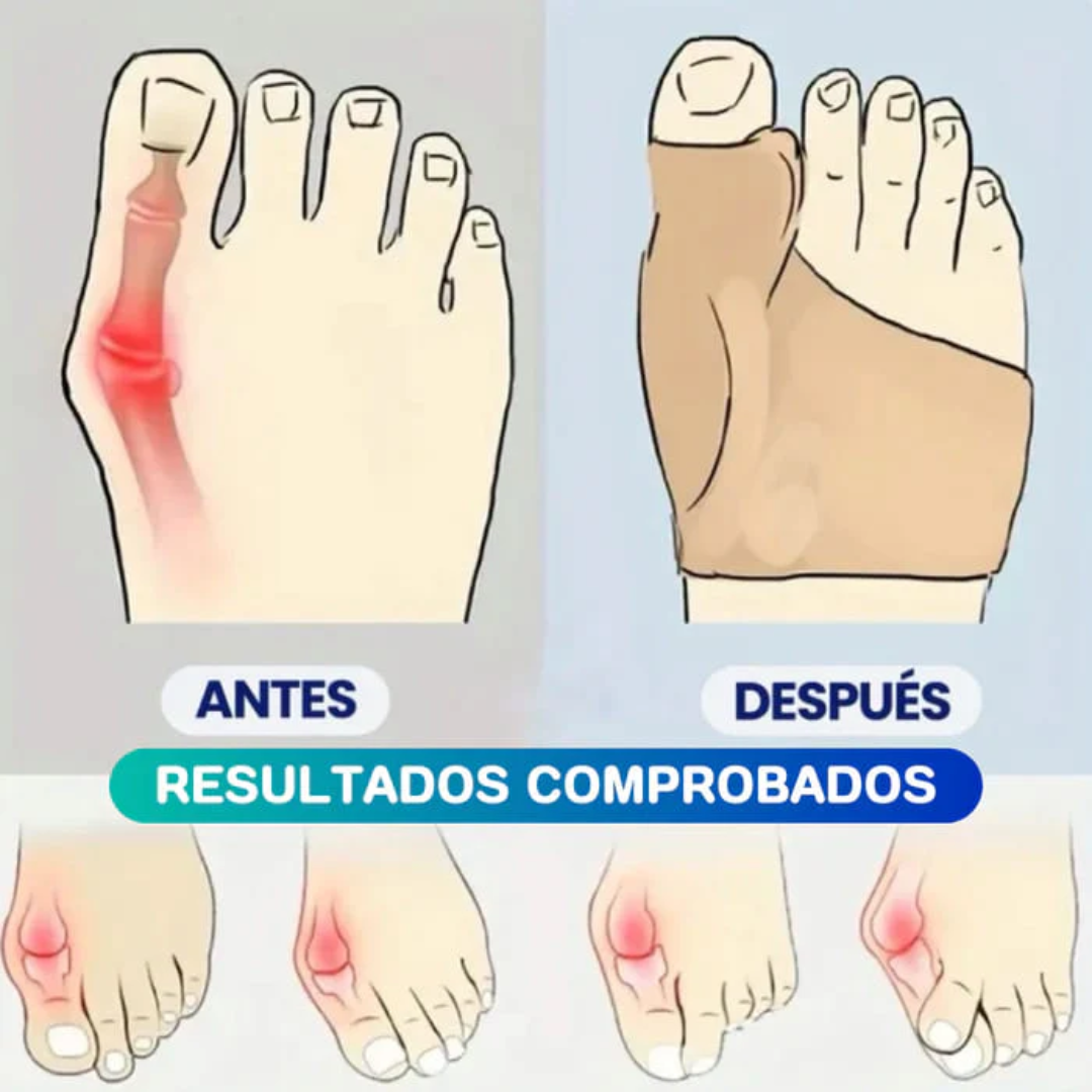 Par Corrector Ortopédico de Juanetes (pack 2 uds)-Chumita Shop.